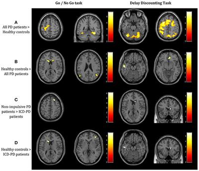 Disruption of Multiple Distinctive Neural Networks Associated With Impulse Control Disorder in Parkinson's Disease